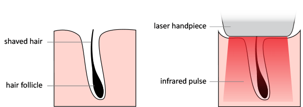 laser-how-it-works